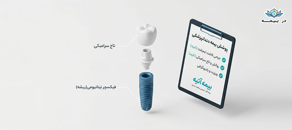 نمودار-اجزای-فیکسچر-و-روکش-دندان-در-فرآیند-درمان-ایمپلنت-با-بیمه-دانا