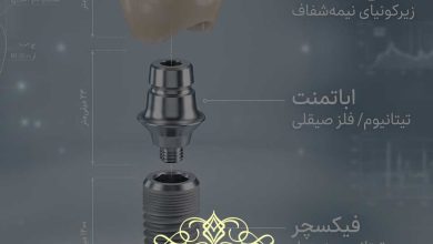راهنمای قیمت ایمپلنت دندان 1405
