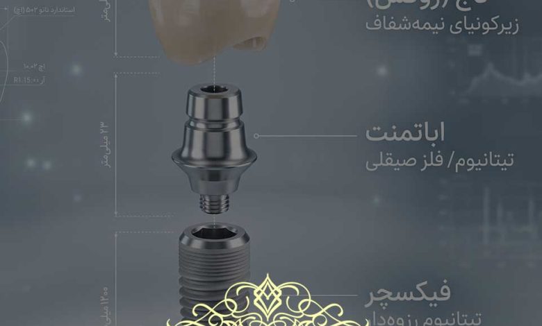 راهنمای قیمت ایمپلنت دندان 1405
